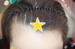 -大麦微针植发全国连锁