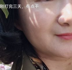 体验前-苏州奥拉克美容医院