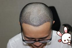 -大麦微针植发丨全国连锁