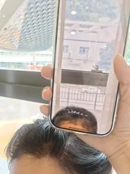 -碧莲盛·不剃发植发