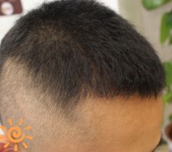 -大麦微针植发丨全国连锁