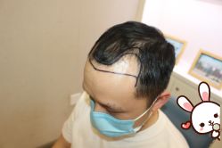 -大麦微针植发丨全国连锁