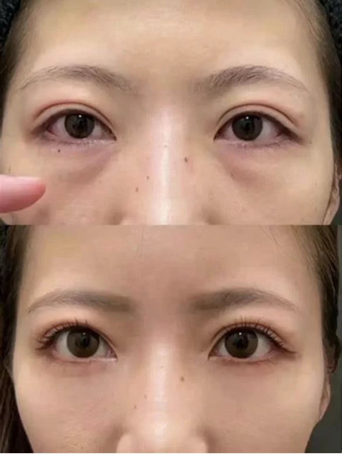 我愿意称内切眼袋为上班族的福音