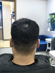 体验后-大麦微针植发全国连锁