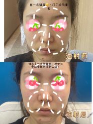 -More摩尔医美の注射线雕光电中心