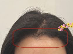 -大麦微针植发全国连锁