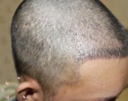 -大麦微针植发丨全国连锁