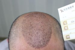 -大麦微针植发丨全国连锁