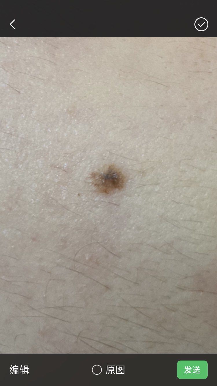 这种点过两次的色素痣,还是要做手术比较好,它的颜色也不均匀了,边缘