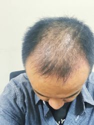 点击看大图 体验后-大麦微针植发全国连锁