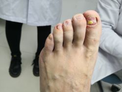 -派恩宜灰指甲鸡眼嵌甲手足癣