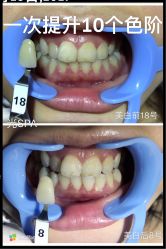 光SPA美白牙齿-光SPA科技美肤