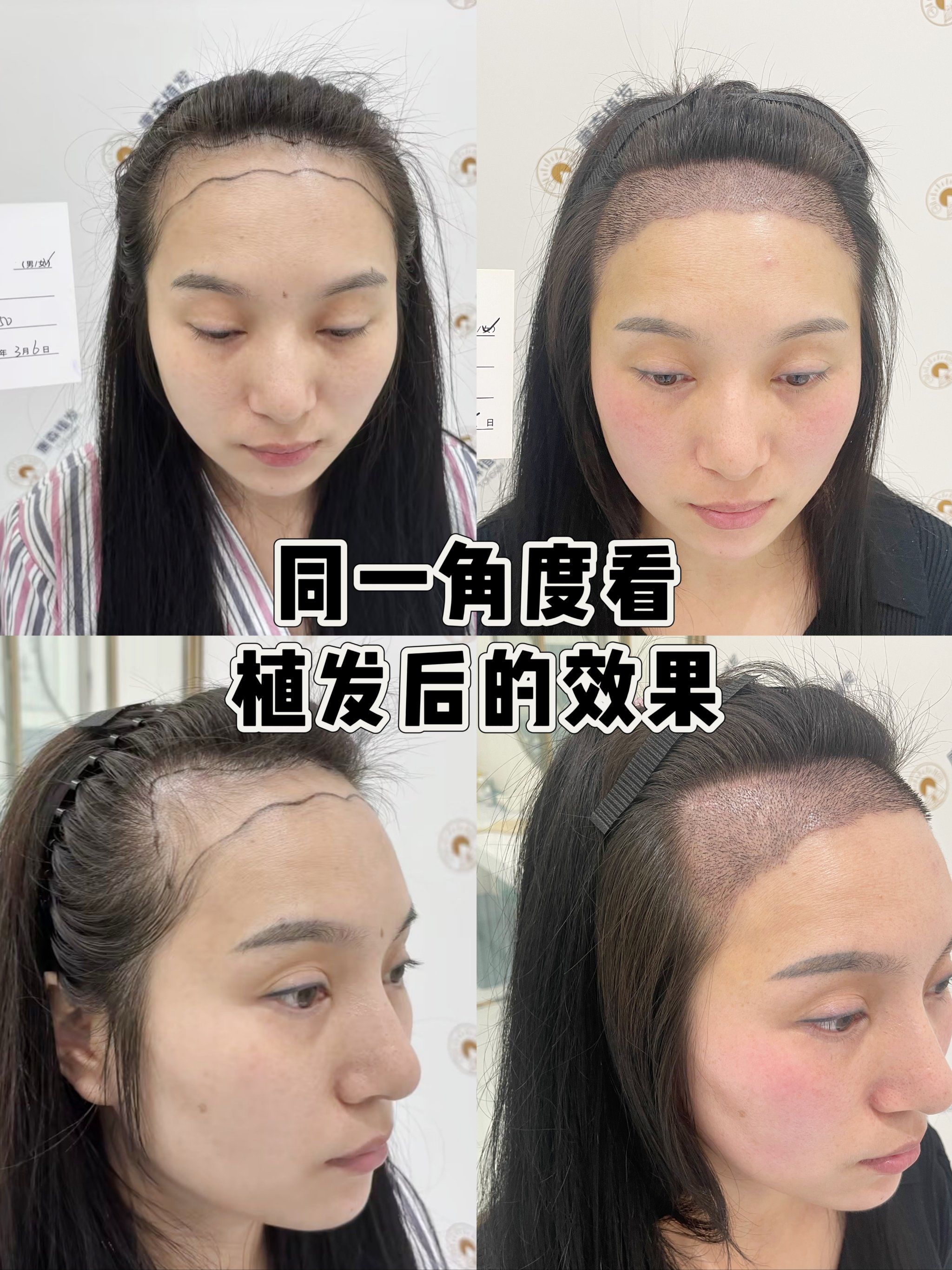 同角度对比看发际线种植10天的真实效果