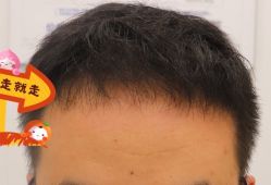 -大麦微针植发全国连锁