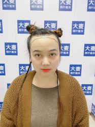 -大麦微针植发丨全国连锁