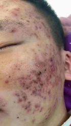 -苗方清颜专业祛痘连锁机构