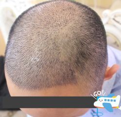 -大麦微针植发丨全国连锁