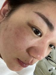 -苗方清颜专业祛痘连锁机构