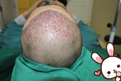 点击看大图 -大麦微针植发丨全国连锁