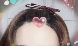 -大麦微针植发全国连锁