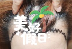 -大麦微针植发全国连锁