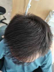 -大麦微针植发丨全国连锁