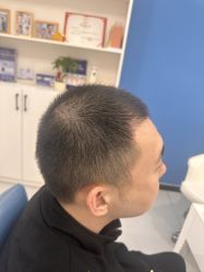 点击看大图 -大麦微针植发全国连锁