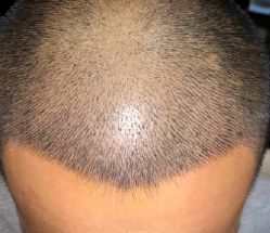 -大麦微针植发全国连锁