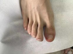 -德哥灰指甲脚气甲沟炎跖疣护理