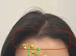 -大麦微针植发全国连锁