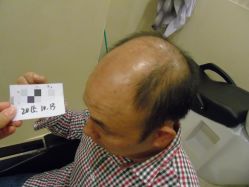 -碧莲盛·不剃发植发