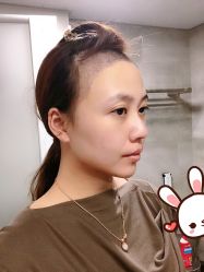 -大麦微针植发丨全国连锁