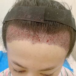 -碧莲盛·不剃发植发