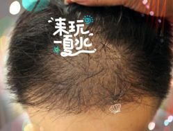 -大麦微针植发全国连锁