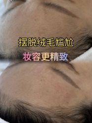 -薇兰专业脱毛连锁机构