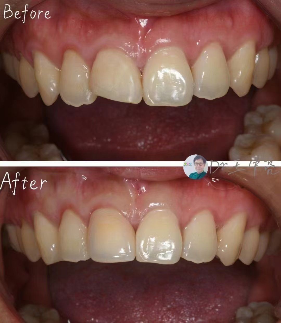 外伤导致门牙缺损 这多影响美观呀
67