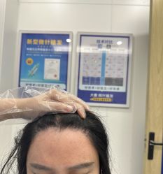 -大麦微针植发全国连锁