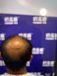 -碧莲盛·不剃发植发