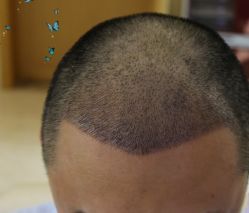 -大麦微针植发丨全国连锁