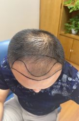 -大麦微针植发全国连锁