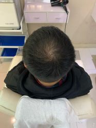 -大麦微针植发全国连锁