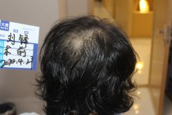 -大麦微针植发丨全国连锁