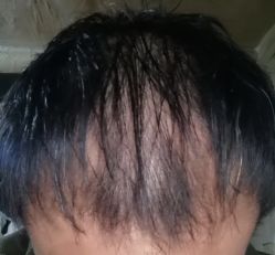 -碧莲盛·不剃发植发