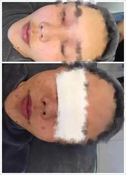 -瓷肌博士·祛痘科技美肤