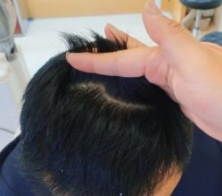 -大麦微针植发全国连锁