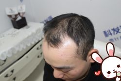 -大麦微针植发丨全国连锁