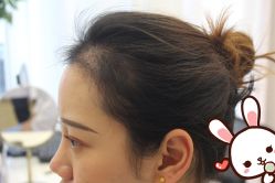 -大麦微针植发丨全国连锁