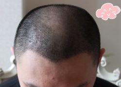 -大麦微针植发丨全国连锁