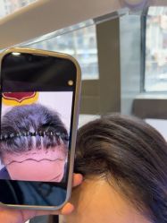 -碧莲盛·不剃发植发