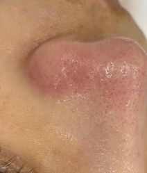 体验后-蕾特恩专业祛痘皮肤管理